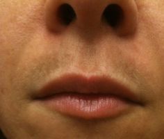 How to get rid of dark skin above upper lip